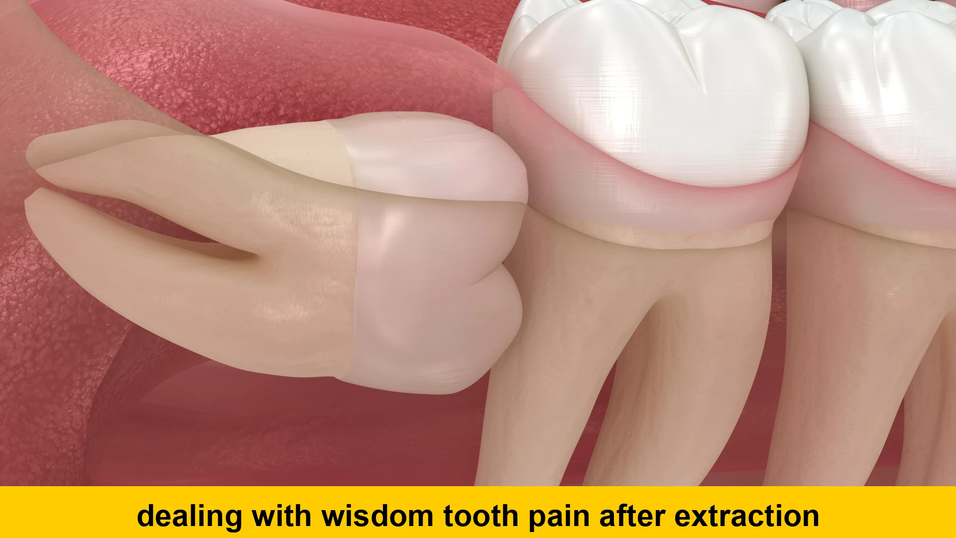 dealing with wisdom tooth pain after extraction