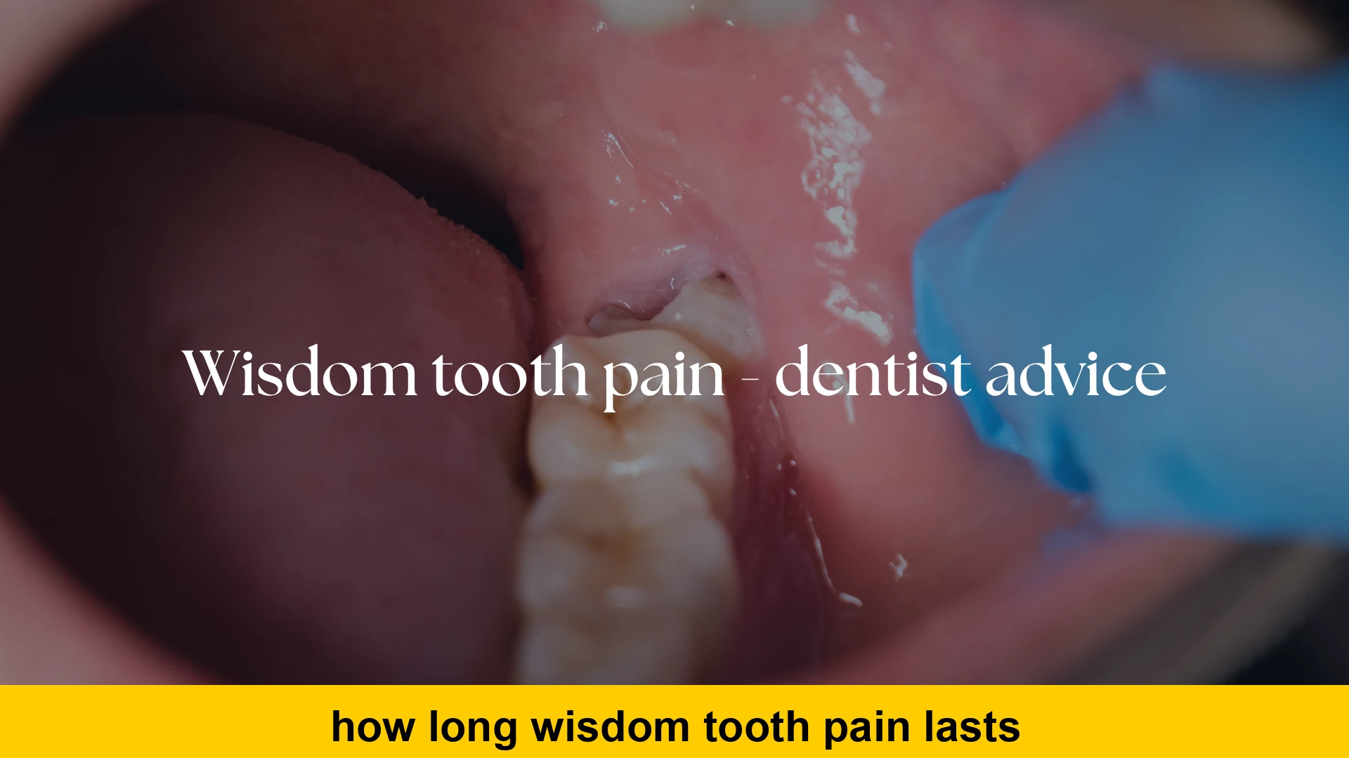how long wisdom tooth pain lasts