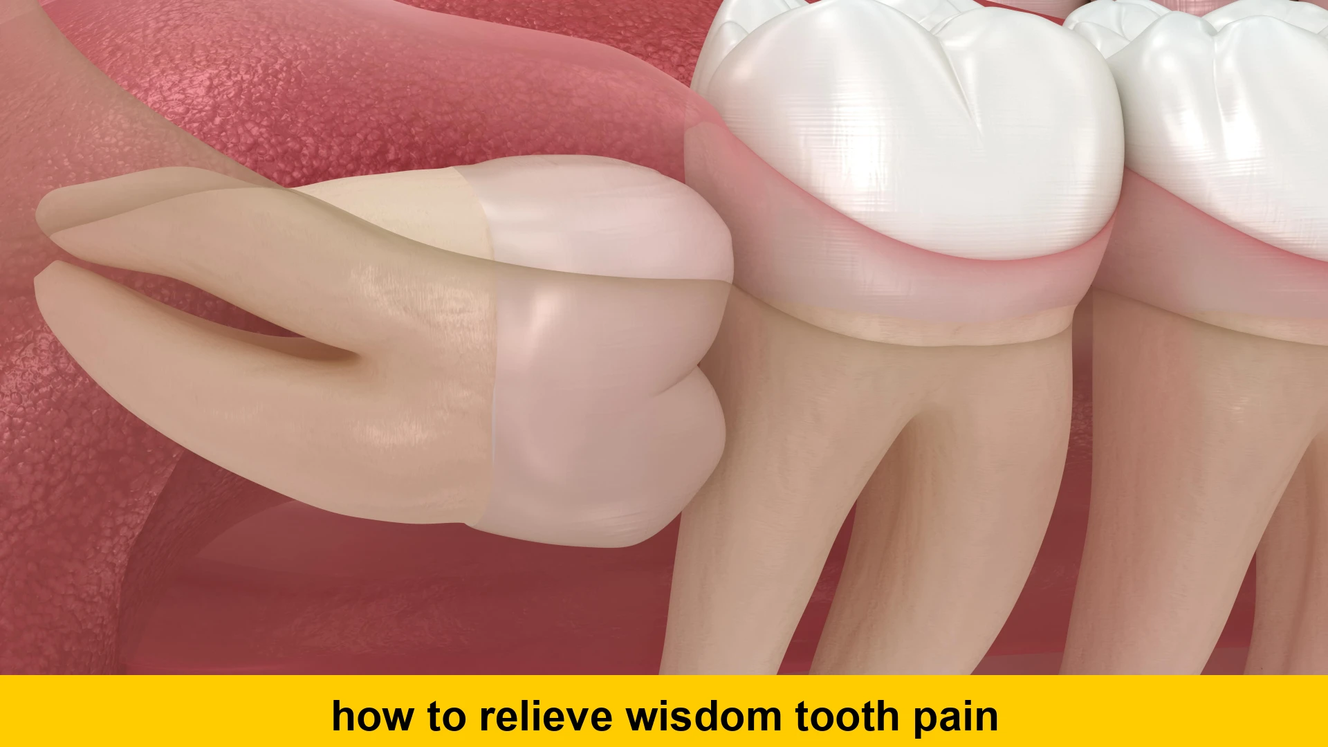 how to relieve wisdom tooth pain