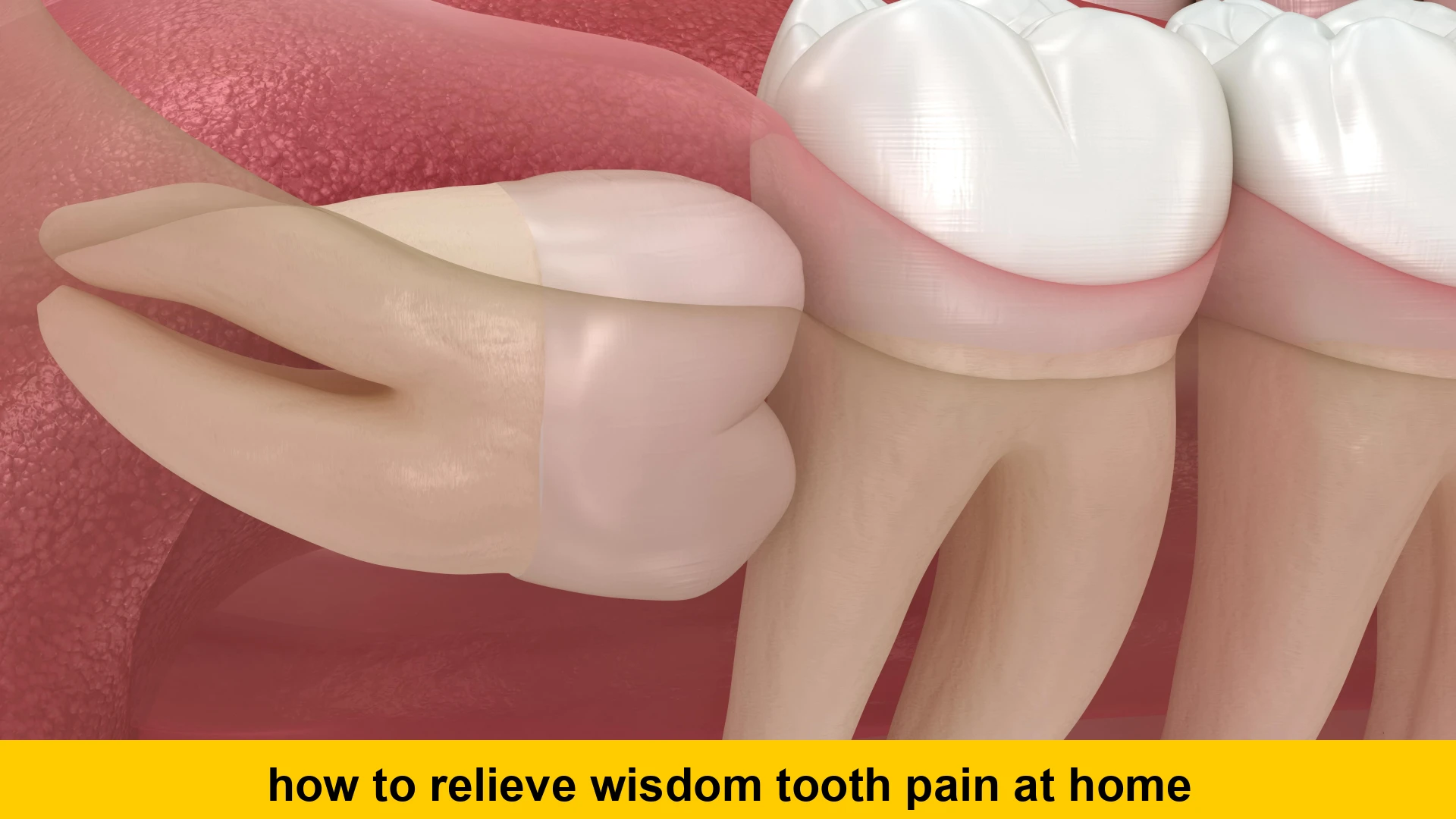how to relieve wisdom tooth pain at home