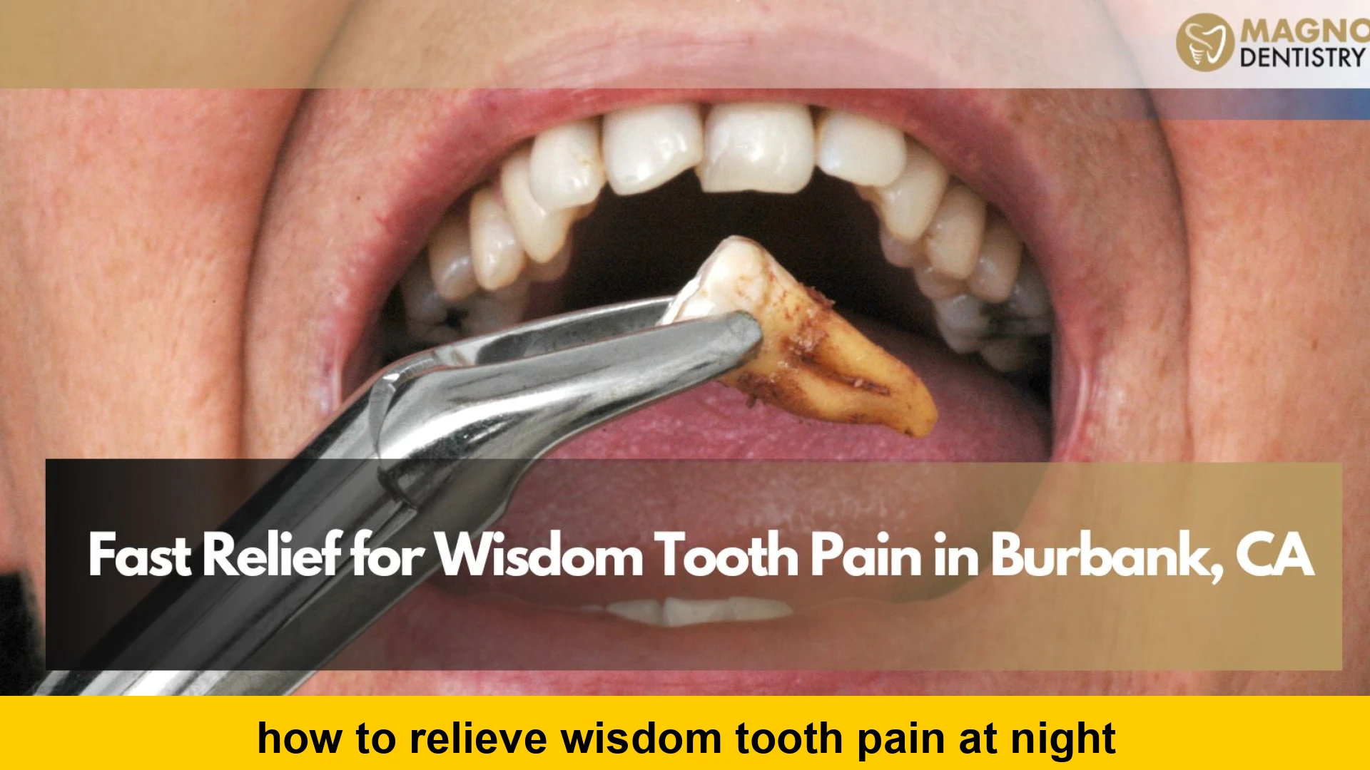 how to relieve wisdom tooth pain at night
