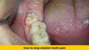 how to stop wisdom tooth pain