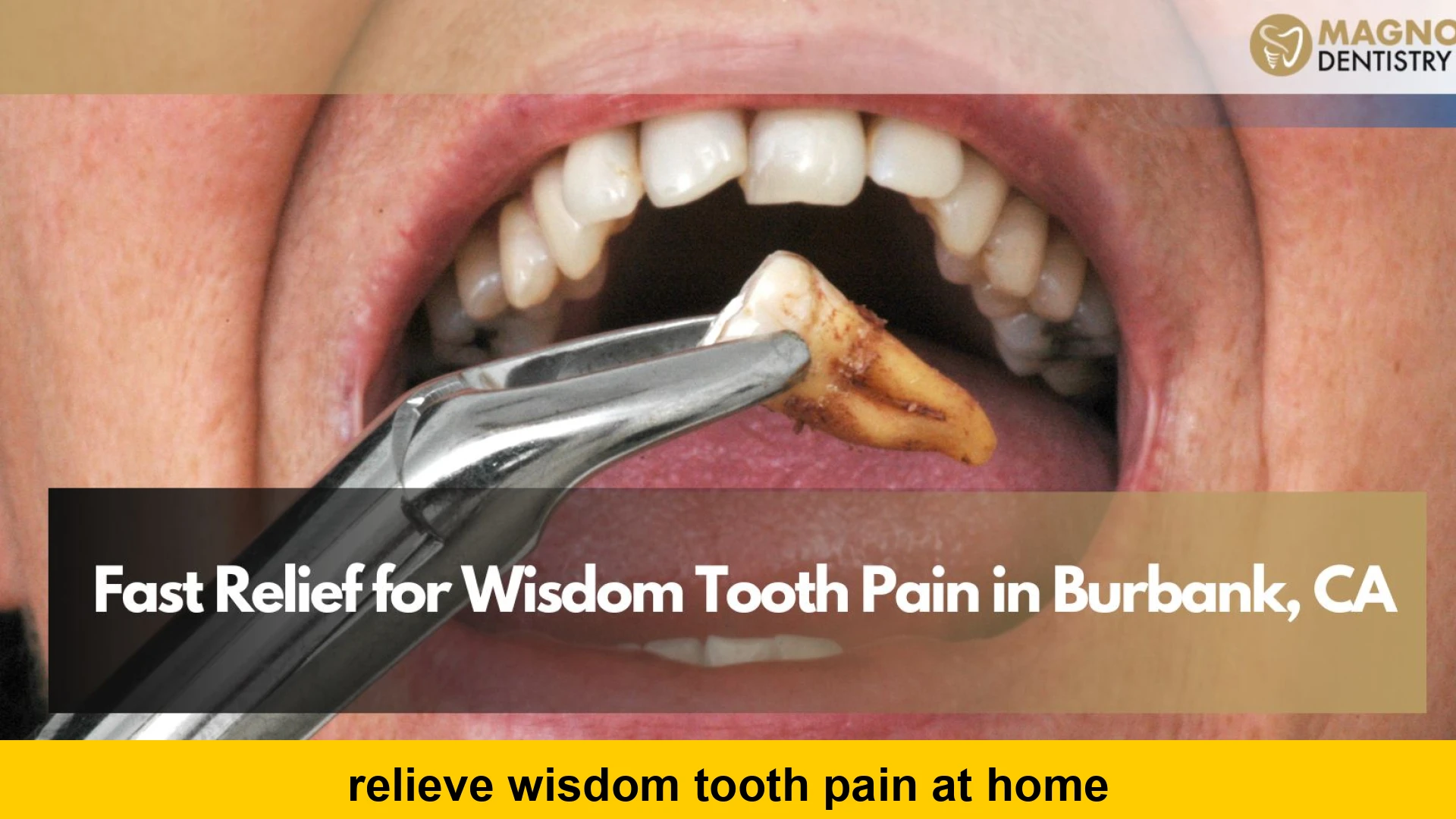 relieve wisdom tooth pain at home