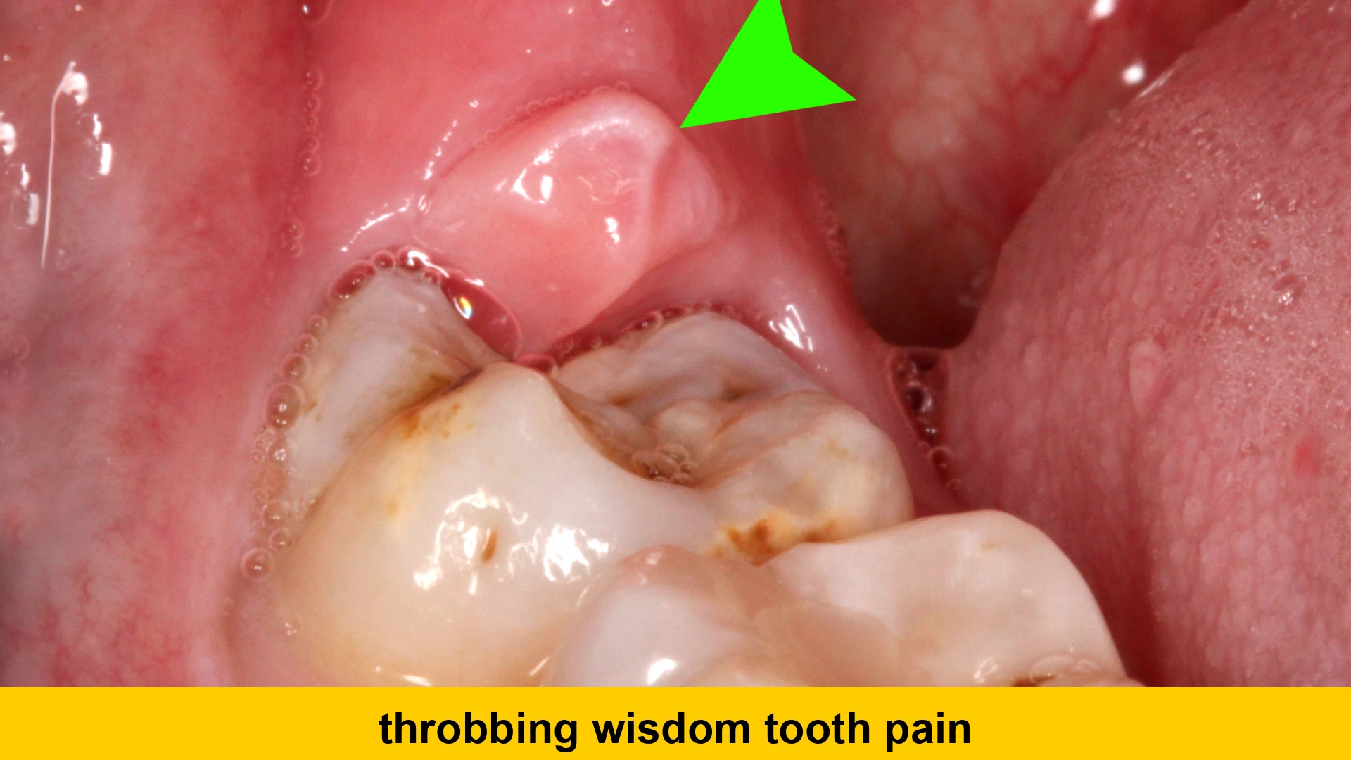 throbbing wisdom tooth pain
