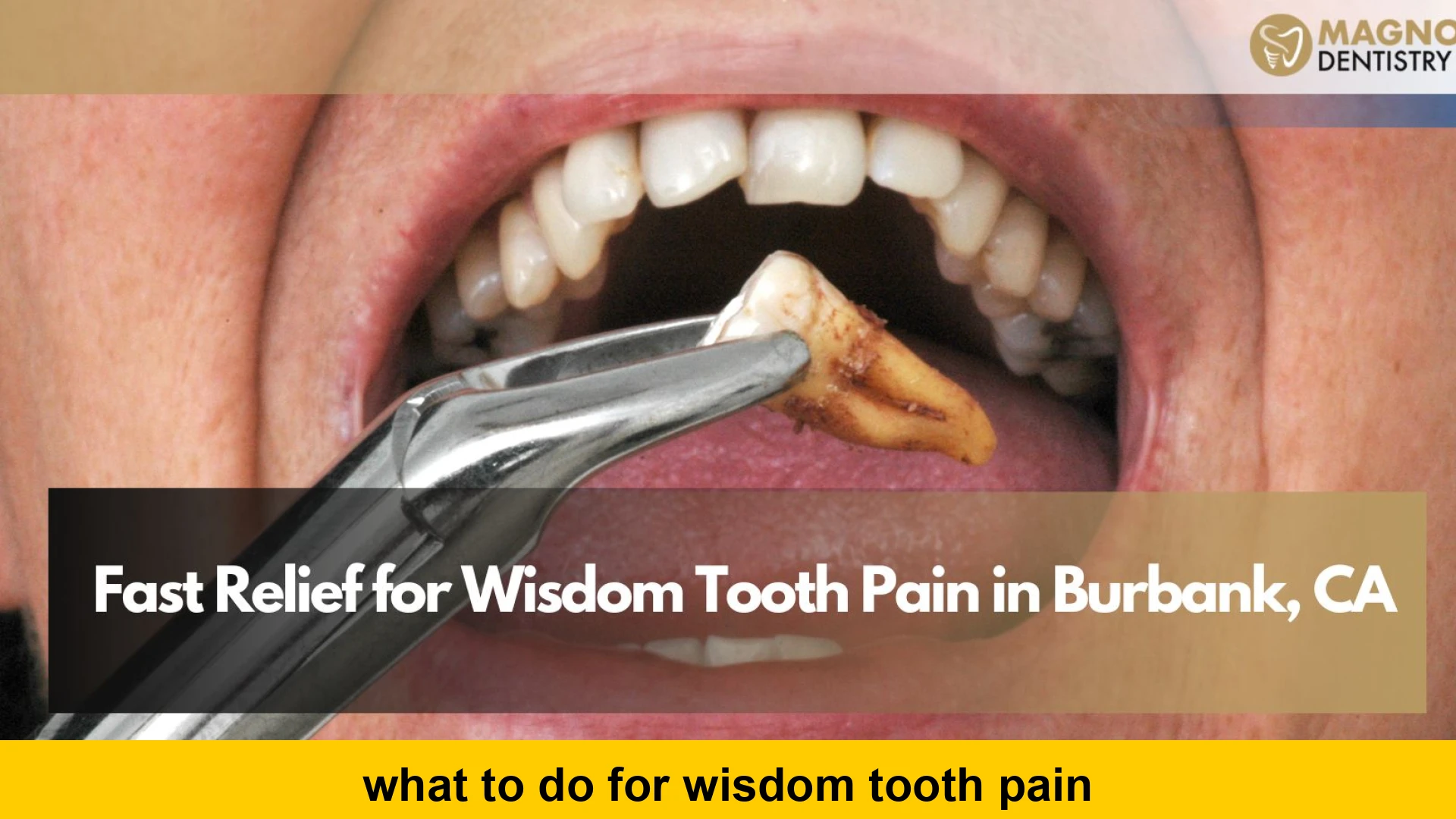what to do for wisdom tooth pain