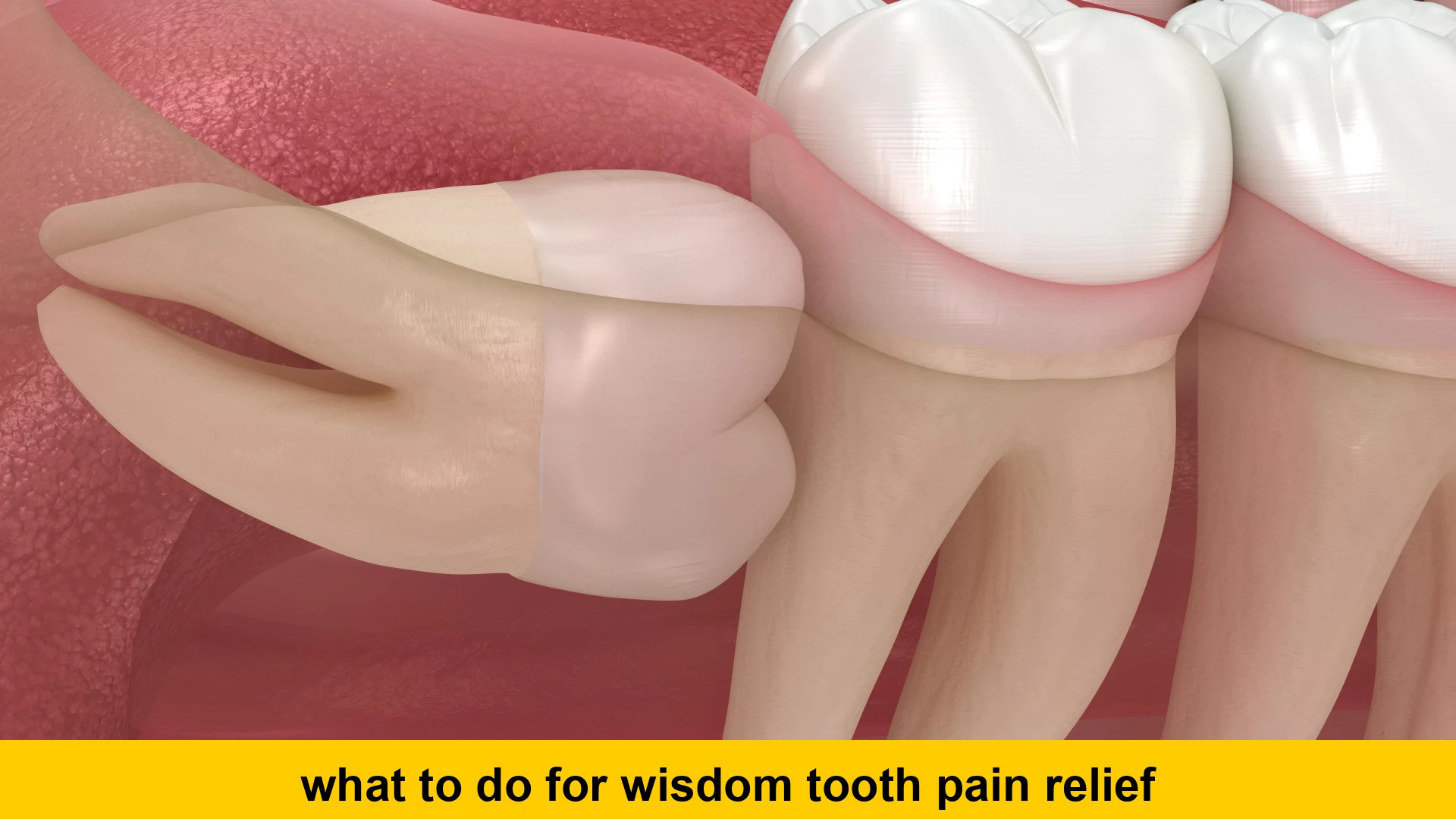 what to do for wisdom tooth pain relief