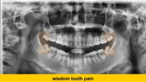 wisdom tooth pain