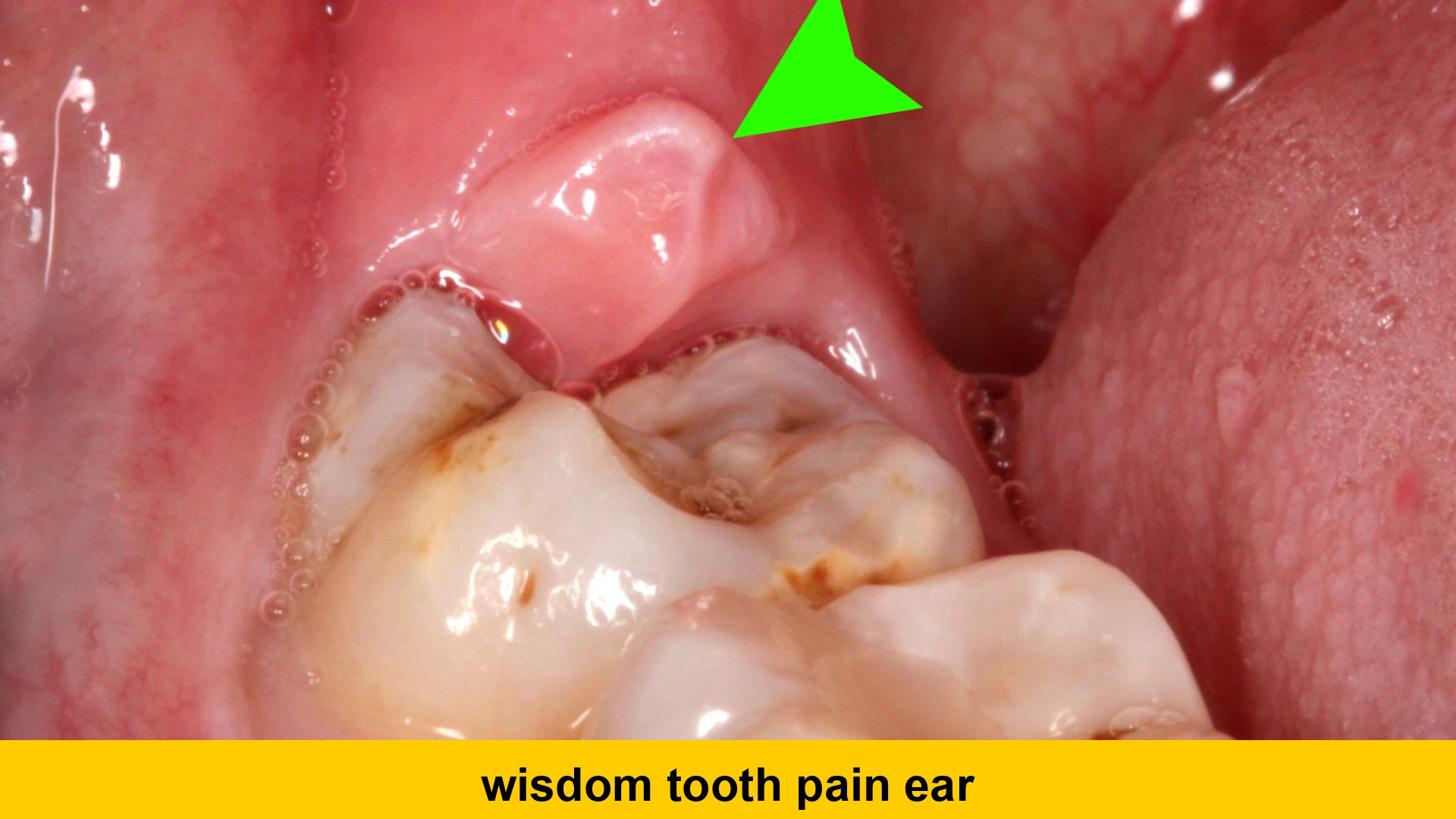 wisdom tooth pain ear