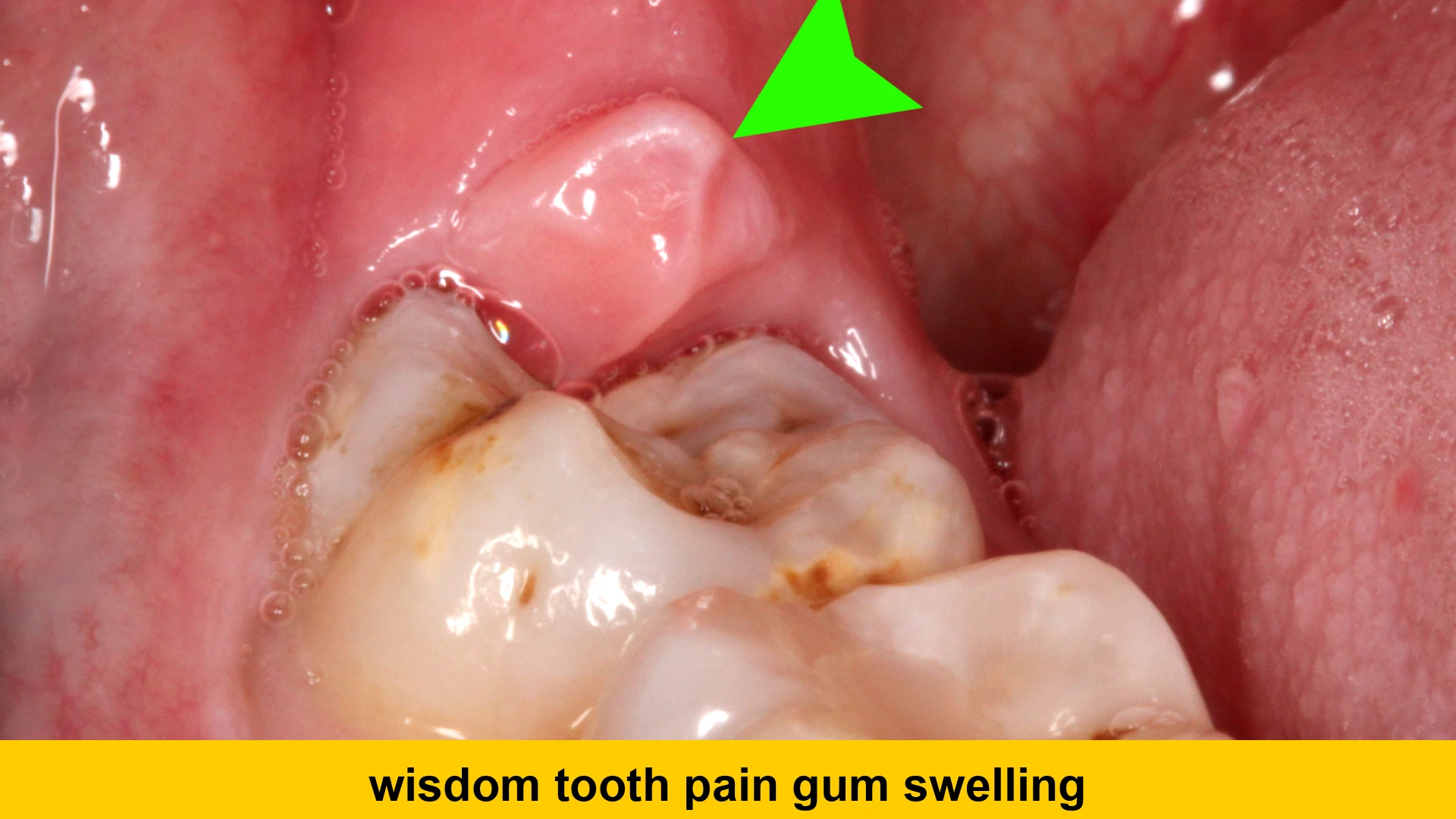 wisdom tooth pain gum swelling