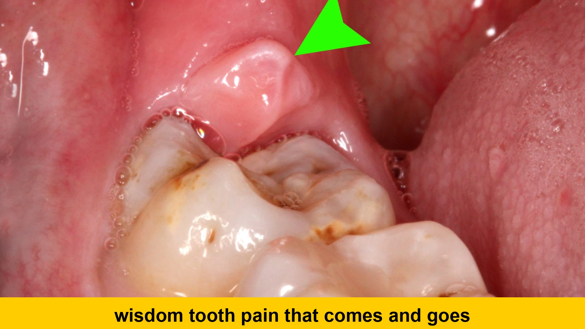 wisdom tooth pain that comes and goes