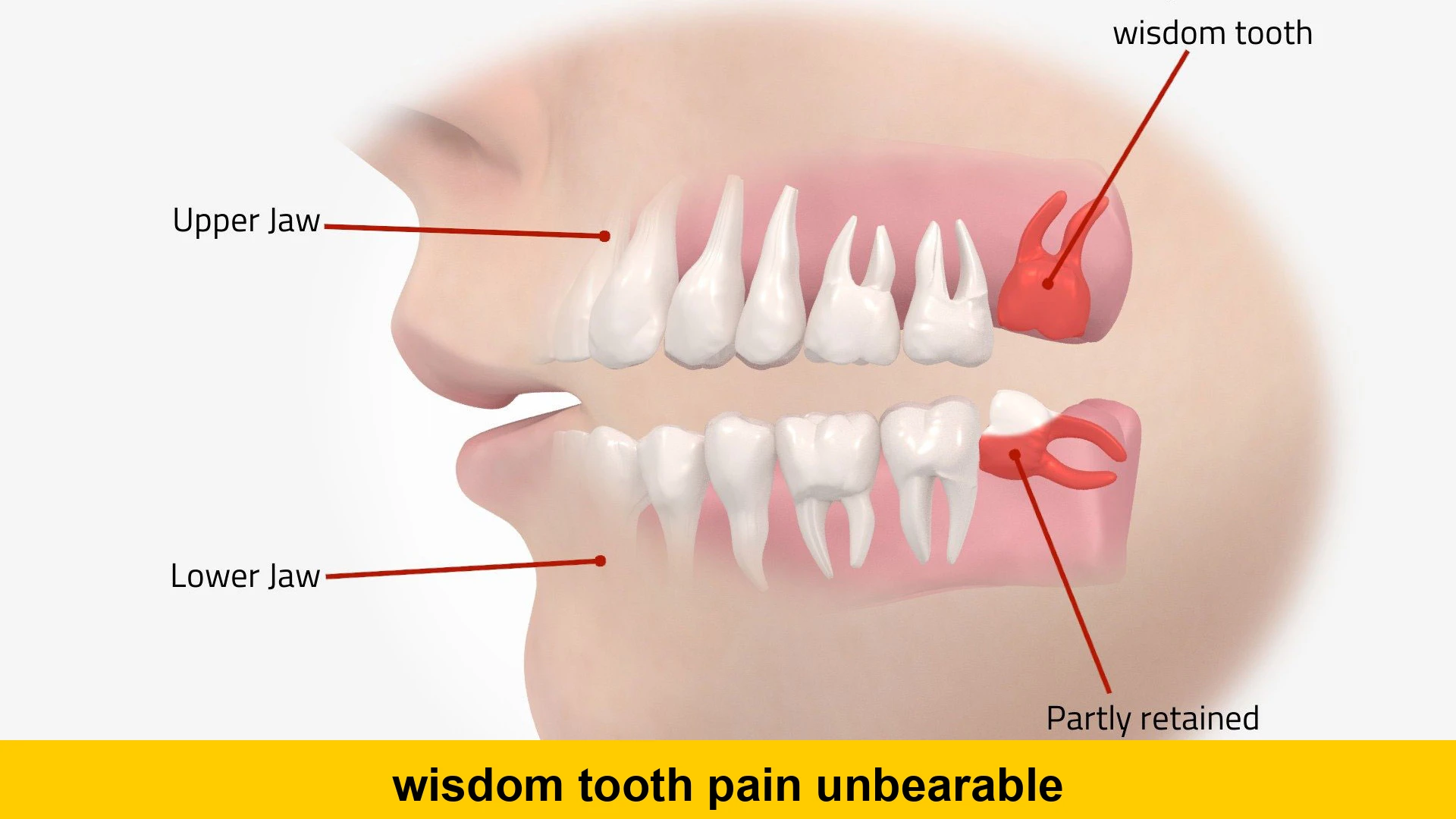 wisdom tooth pain unbearable