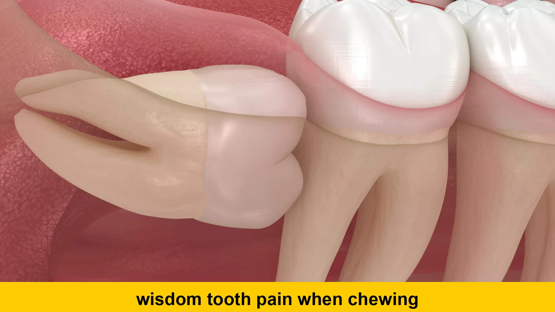 wisdom tooth pain when chewing